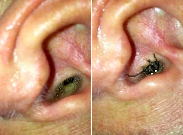 паук в ухе, парень снял паук в ухе, снял на смартфон паука в ухе, Брюс Брендит, Bruce Brandit