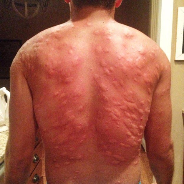 страшно покусали комары, очень сильно искусали комары, искусали комары фото