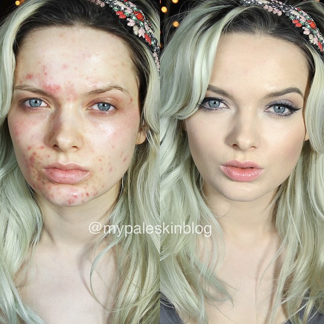 Эм Форд, Em Ford, Девушка с проблемной кожей сняла мощное видео, девушка с проблемной кожей