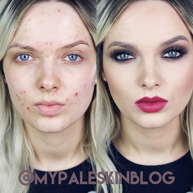 Эм Форд, Em Ford, Девушка с проблемной кожей сняла мощное видео, девушка с проблемной кожей