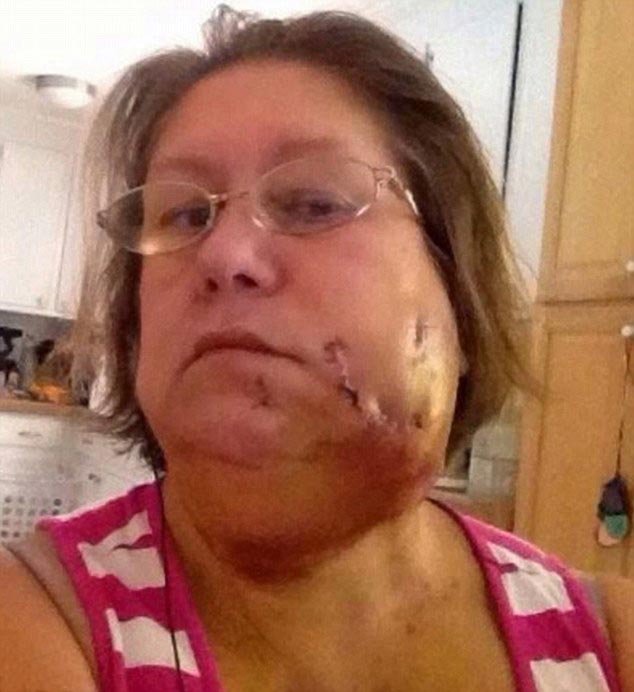 Лицо женщины после того, как ей чуть не откусил щеку питбуль Бренда Ригдон, Brenda Rigdon, питбуль укусил за щеку, собака укусила женщину за щеку, лицо женщины укусил питбуль