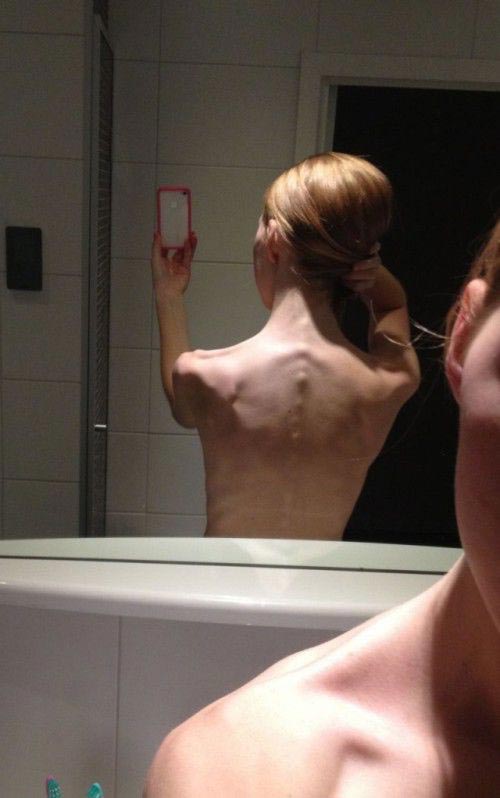 девушка вылечилась от анорексии, из анорексички в спортсменку, анорексичка накачалась, девушка анорексия спорт, дои после анорексии