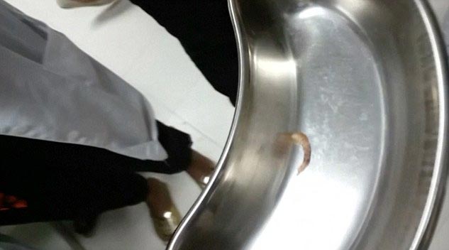 червь в глазу, врач достал червя из глаза, врач достал червя из глаза видео, червь в глазу базилик