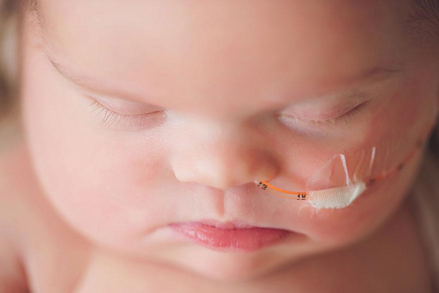 Девочка  с неоперабельной опухолью мозга, Абигейл Джонс, Abigail Jones