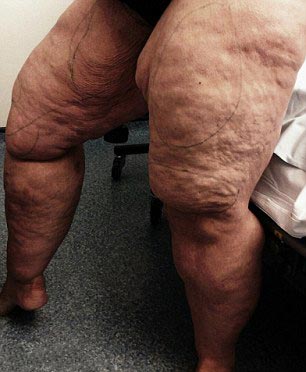 лечение липедемы, жир на ногах женщины липедема, пластическая операция липедема, липосакция липедема, откачка жира с ног липедема