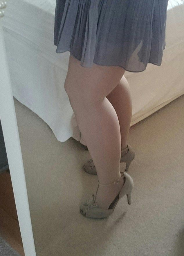 Женщине пришлось откачать 12 литров жира с бедер, чтобы её ноги стали выглядеть нормально лечение липедемы, жир на ногах женщины липедема, пластическая операция липедема, липосакция липедема, откачка жира с ног липедема