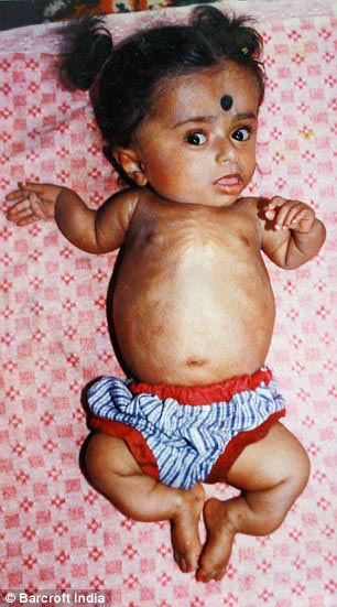 Гириджа Шринивас,Girija Srinivas, девушка в теле 2-летней девочки, девушка в теле двухлетней девочки, 