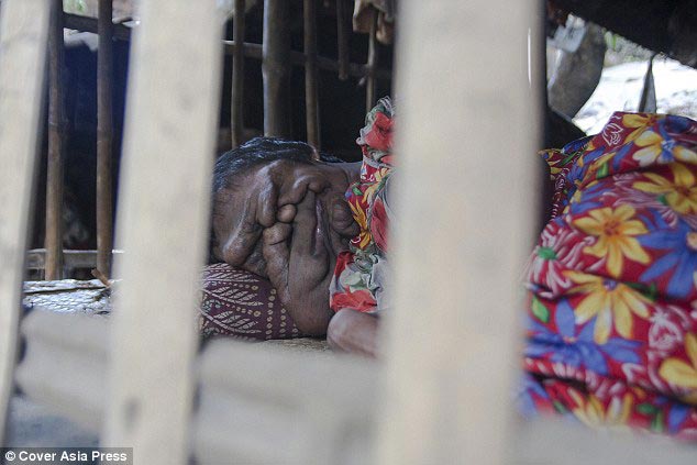 Хадиджа Хатун, Khadija Khatoon, девушка с наростами на лице, наросты на лице нейрофиброматоз