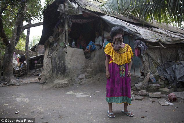 Хадиджа Хатун, Khadija Khatoon, девушка с наростами на лице, наросты на лице нейрофиброматоз