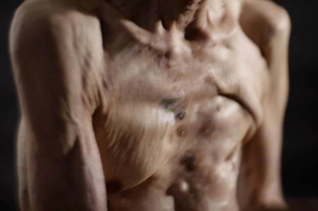 Сумитэру Танигучи, Sumiteru Taniguchi, шрамы после атомного взрыва, японец показал шрамы от ядерного взрыва, 