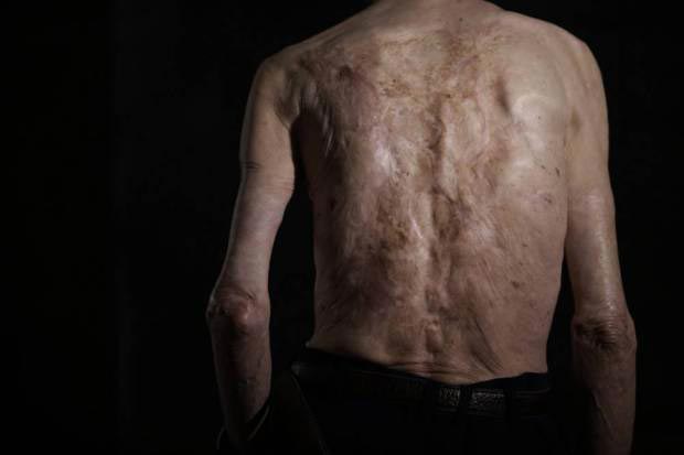 Сумитэру Танигучи, Sumiteru Taniguchi, шрамы после атомного взрыва, японец показал шрамы от ядерного взрыва, 