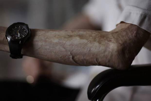 Сумитэру Танигучи, Sumiteru Taniguchi, шрамы после атомного взрыва, японец показал шрамы от ядерного взрыва, 