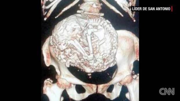 рентгену 120 лет, самые интересные рентгеновские снимки, шокирующие рентгеновские снимки