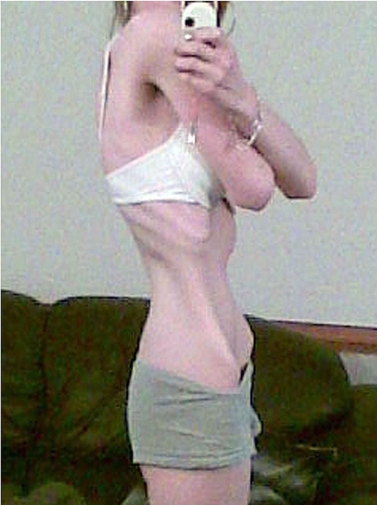 Меган Армер, Megan Armer, анорексичка стала моделью, от анорексии и стала моделью, девушка победила анорексию, анорексия до и после