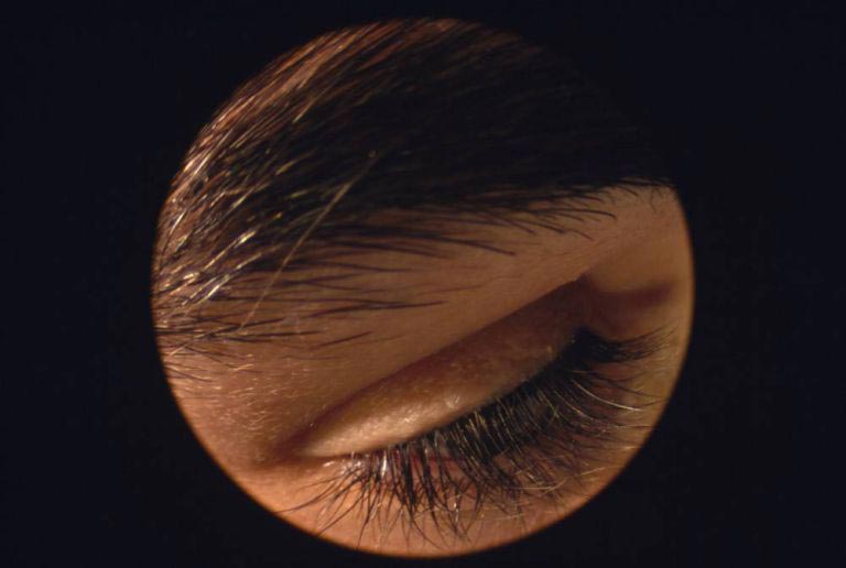 demodex, демодекс, железница, клещи на лице, клещи живут на нашем лице