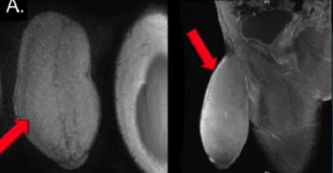 Подросток прошел через первую в мире операцию по уменьшению пeниca операция по уменьшению, первая операция по уменьшению