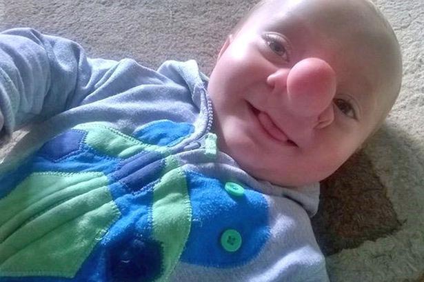 Олли Трезис, Ollie Trezise, реальный Пиноккио, мальчик родился с частью мозга в носу,ребенок с энцефалоцеле