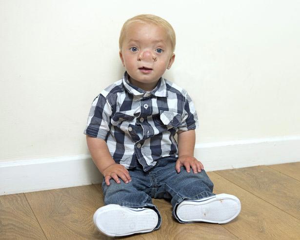 Олли Трезис, Ollie Trezise, реальный Пиноккио, мальчик родился с частью мозга в носу,ребенок с энцефалоцеле