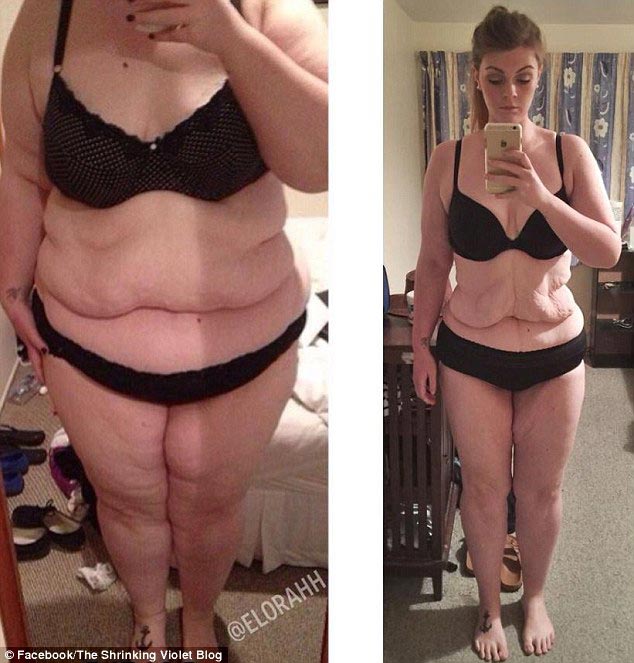 лишние складки кожи после похудения, рулоны лишней кожи, лишняя кожа после похудения