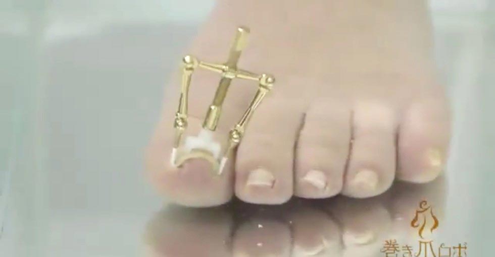 Makizume Robo, изобретение против вросшего ногтя, изобретение против вросших ногтей