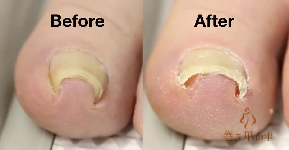 Makizume Robo, изобретение против вросшего ногтя, изобретение против вросших ногтей