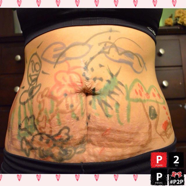 Полюби свои линии, полюби свои растяжки, женщины размещают фотографии своих растяжек, #LoveYourLines, Крисси Тейген