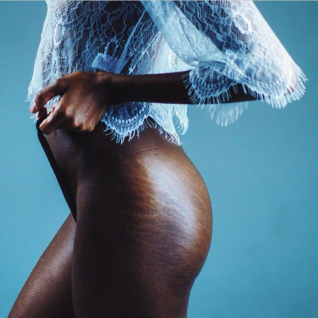 Полюби свои линии, полюби свои растяжки, женщины размещают фотографии своих растяжек, #LoveYourLines, Крисси Тейген