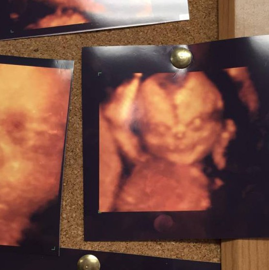 Пара решила не делать УЗИ будущего ребенка, увидев снимок жуткого демона на стенде поликлиники 4D снимок УЗИ, жуткий снимок ребенка 4D Узи, пара решила не делать УЗИ увидев фото