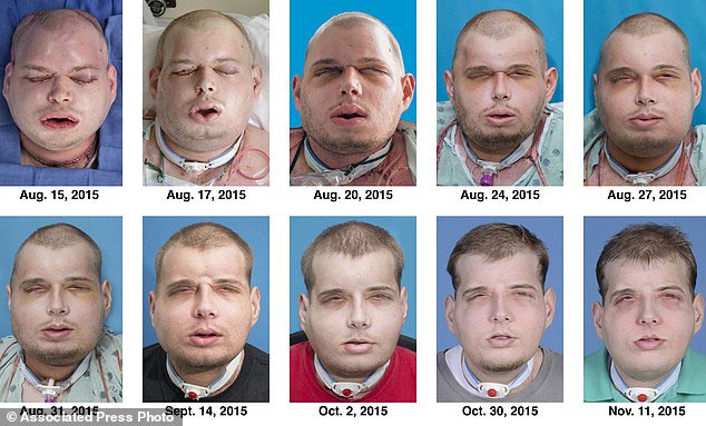 Новое лицо: обгоревший пожарный прошел через самую обширную операцию по пересадке лица в истории Пэт Хардисон, Pat Hardison, Дэвид Роудбах, David Rodebaugh, пересадка лица, самая крупная операция по пересадке лица, пересадка лица 2015