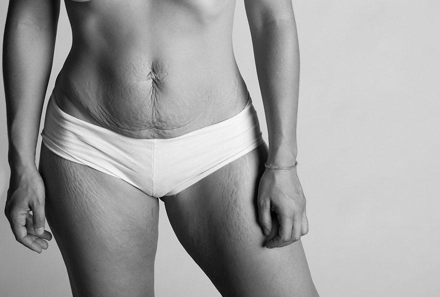 После беременности: правдивые фотографии, показывающие тела рожавших женщин Джейд Билл, Jade Beall, женщины после родов, растяжки после родов