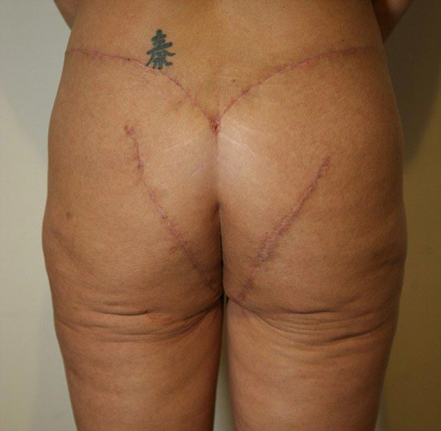 неудачная подтяжка ягодиц, неудачная пластическая операция