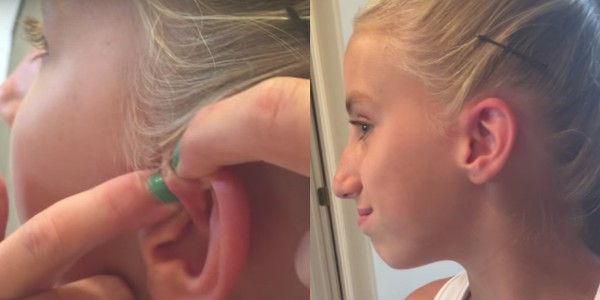 выдавила прыщ выращивала 6 лет, выдавила шестилетний прыщ, девочка выдавила прыщ шесть лет