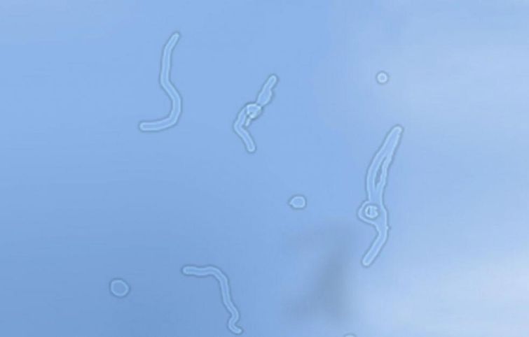 прозрачные мушки перед глазами, прозрачные штуки перед глазами, прозрачные белые плавающие перед глазами