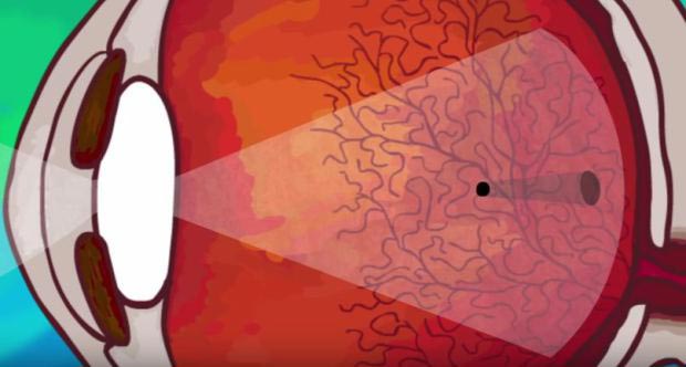 прозрачные мушки перед глазами, прозрачные штуки перед глазами, прозрачные белые плавающие перед глазами