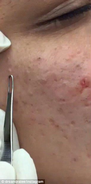 доктор выдавливатель прыщей, выдавливатель прыщей, Сандра Ли, Sandra Lee, прославилась выдавливая прыщи, выдавливает прыщи видео