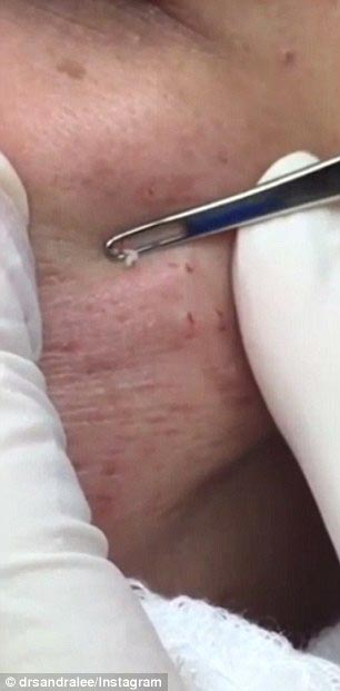 доктор выдавливатель прыщей, выдавливатель прыщей, Сандра Ли, Sandra Lee, прославилась выдавливая прыщи, выдавливает прыщи видео