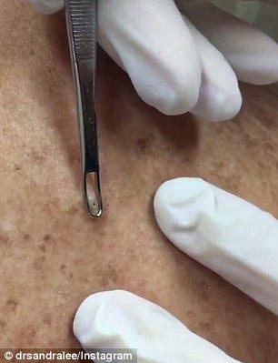 доктор выдавливатель прыщей, выдавливатель прыщей, Сандра Ли, Sandra Lee, прославилась выдавливая прыщи, выдавливает прыщи видео