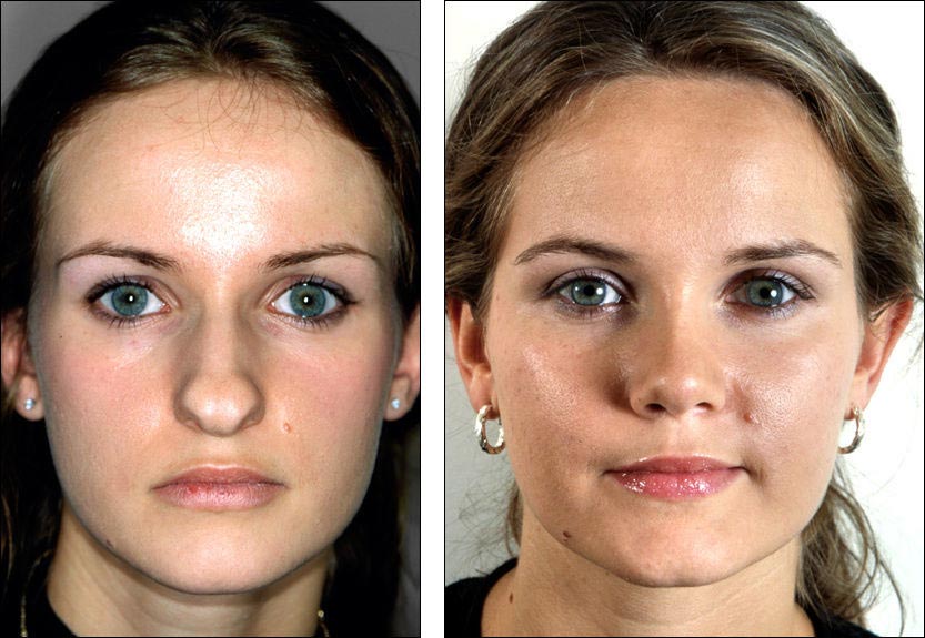 Лабиопластика фото до и после у женщин