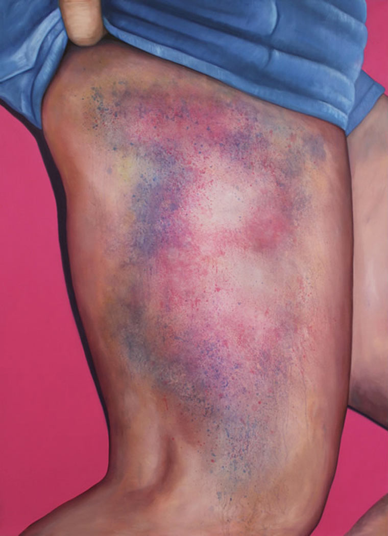 Roller Derby Kisses, Поцелуи роллер-дерби, Риикка Хивонен, Riikka Hyvönen, синяки произведения искусства