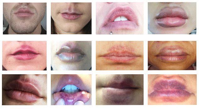 CandyLipz, CandyLipz до и после, губы после CandyLipz, Бриттани Форстер, Brittany Forster