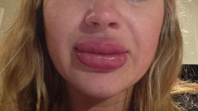 CandyLipz, CandyLipz до и после, губы после CandyLipz, Бриттани Форстер, Brittany Forster