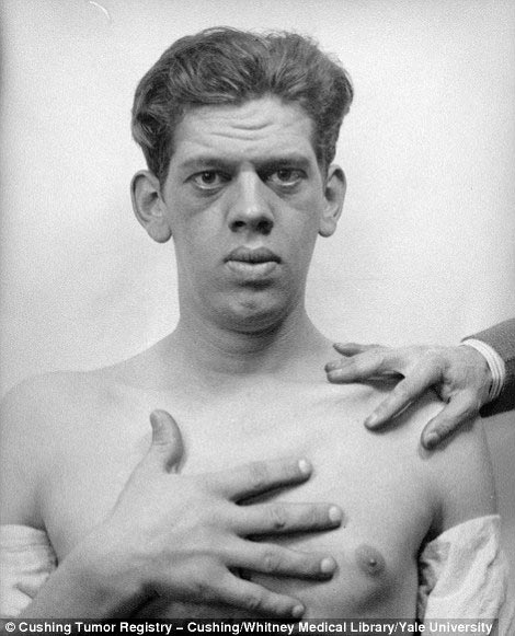 Обнаружены фотографии пациентов, которые перенесли одни из первых операций на мозге Харви Кушингу, Harvey Cushing, первые пациенты хирургии мозга, первые операции головного мозга, фотографии людей хирургия головного мозга