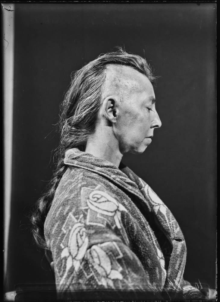 Обнаружены фотографии пациентов, которые перенесли одни из первых операций на мозге Харви Кушингу, Harvey Cushing, первые пациенты хирургии мозга, первые операции головного мозга, фотографии людей хирургия головного мозга