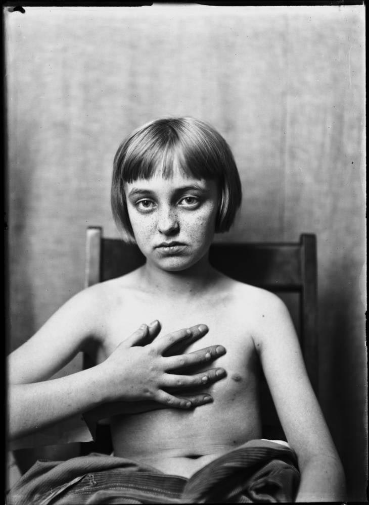 Обнаружены фотографии пациентов, которые перенесли одни из первых операций на мозге Харви Кушингу, Harvey Cushing, первые пациенты хирургии мозга, первые операции головного мозга, фотографии людей хирургия головного мозга