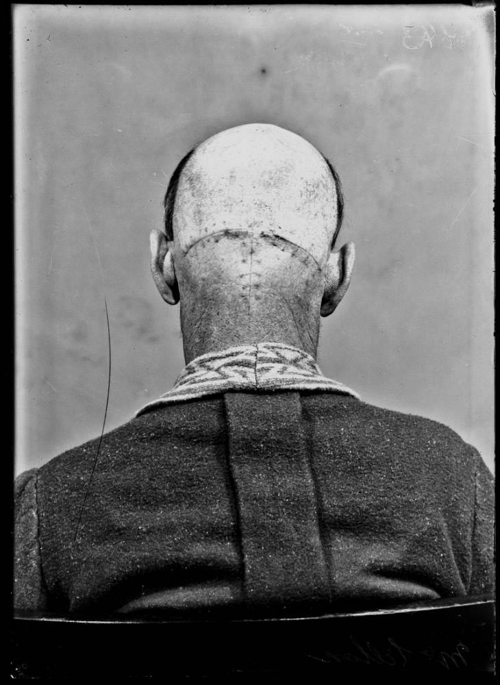 Обнаружены фотографии пациентов, которые перенесли одни из первых операций на мозге Харви Кушингу, Harvey Cushing, первые пациенты хирургии мозга, первые операции головного мозга, фотографии людей хирургия головного мозга