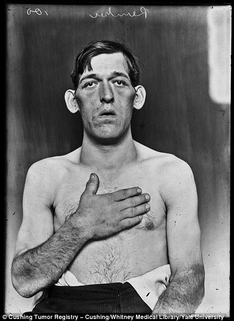 Обнаружены фотографии пациентов, которые перенесли одни из первых операций на мозге Харви Кушингу, Harvey Cushing, первые пациенты хирургии мозга, первые операции головного мозга, фотографии людей хирургия головного мозга
