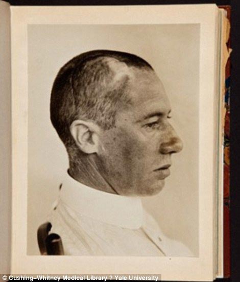 Обнаружены фотографии пациентов, которые перенесли одни из первых операций на мозге Харви Кушингу, Harvey Cushing, первые пациенты хирургии мозга, первые операции головного мозга, фотографии людей хирургия головного мозга