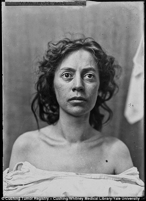 Обнаружены фотографии пациентов, которые перенесли одни из первых операций на мозге Харви Кушингу, Harvey Cushing, первые пациенты хирургии мозга, первые операции головного мозга, фотографии людей хирургия головного мозга