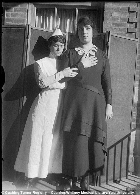 Обнаружены фотографии пациентов, которые перенесли одни из первых операций на мозге Харви Кушингу, Harvey Cushing, первые пациенты хирургии мозга, первые операции головного мозга, фотографии людей хирургия головного мозга
