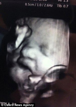 Оуши Варни, Ocea Varney, девочка родилась с большим языком, большой язык не закрывается рот, синдром Беквита-Видеманна